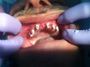 plastic abutments (Copy)