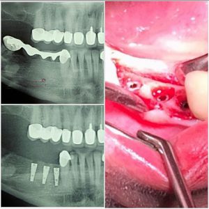 20170317_222120 (Medium)