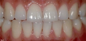 Gingiva -zdrava (Copy)