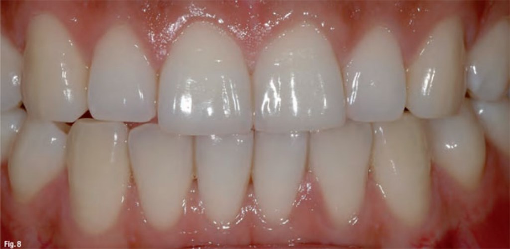 Gingiva Stomatološka ordinacija Jovanovic