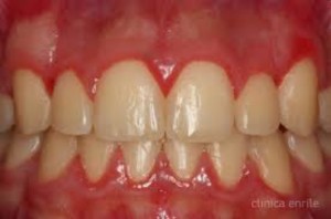 Gingivitis (Copy)