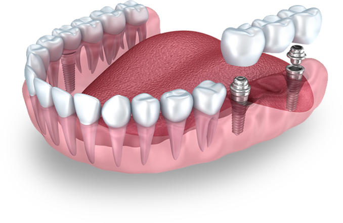 Zubni Implanti
