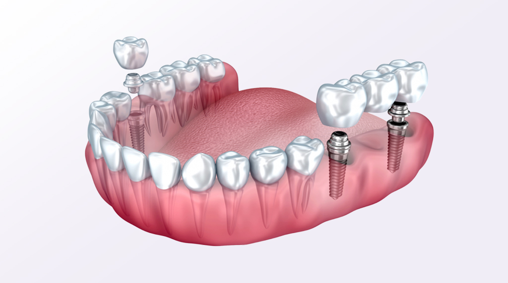 Zubni Implanti Stomatoloska ordinacija Dental Jovanovic